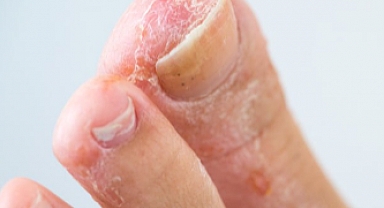 Ayak Mantarı Nedir?