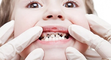 Çocuklarda Diş Çürüğü Riskini Azaltmanın Yolları: Hijyen, Beslenme ve Bilinçlendirme