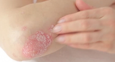 Sedef Hastalığında Beslenmenin Rolü: Semptomları Hafifletmek İçin Beslenme Tüyoları