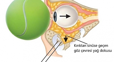 TENİS'te POTANSİYEL TEHLİKE: BLOW OUT KIRIKLARI!
