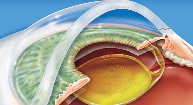 Görme Teknolojisinde Devrim: GÖZ İÇİ AKILLI LENSLER